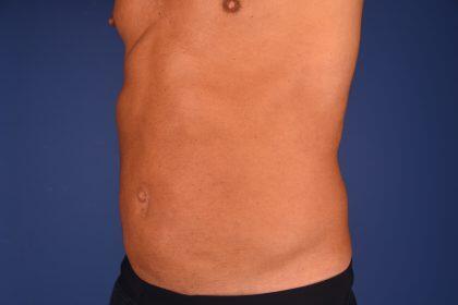 Liposuction Before & After Image